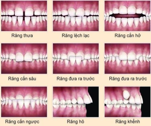 Niềng Răng